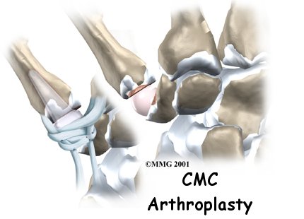 Artificial Joint Replacement of the Thumb - Peak Performance Physical Therapy's Guide