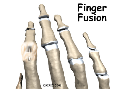 Finger Fusion Surgery - Peak Performance Physical Therapy's Guide