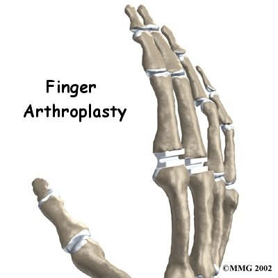 Artificial Joint Replacement of the Finger - Peak Performance Physical Therapy's Guide