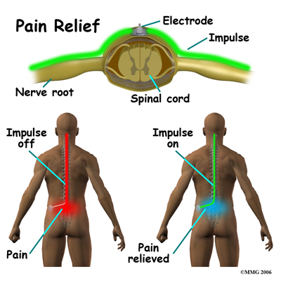 Spinal Cord Stimulators